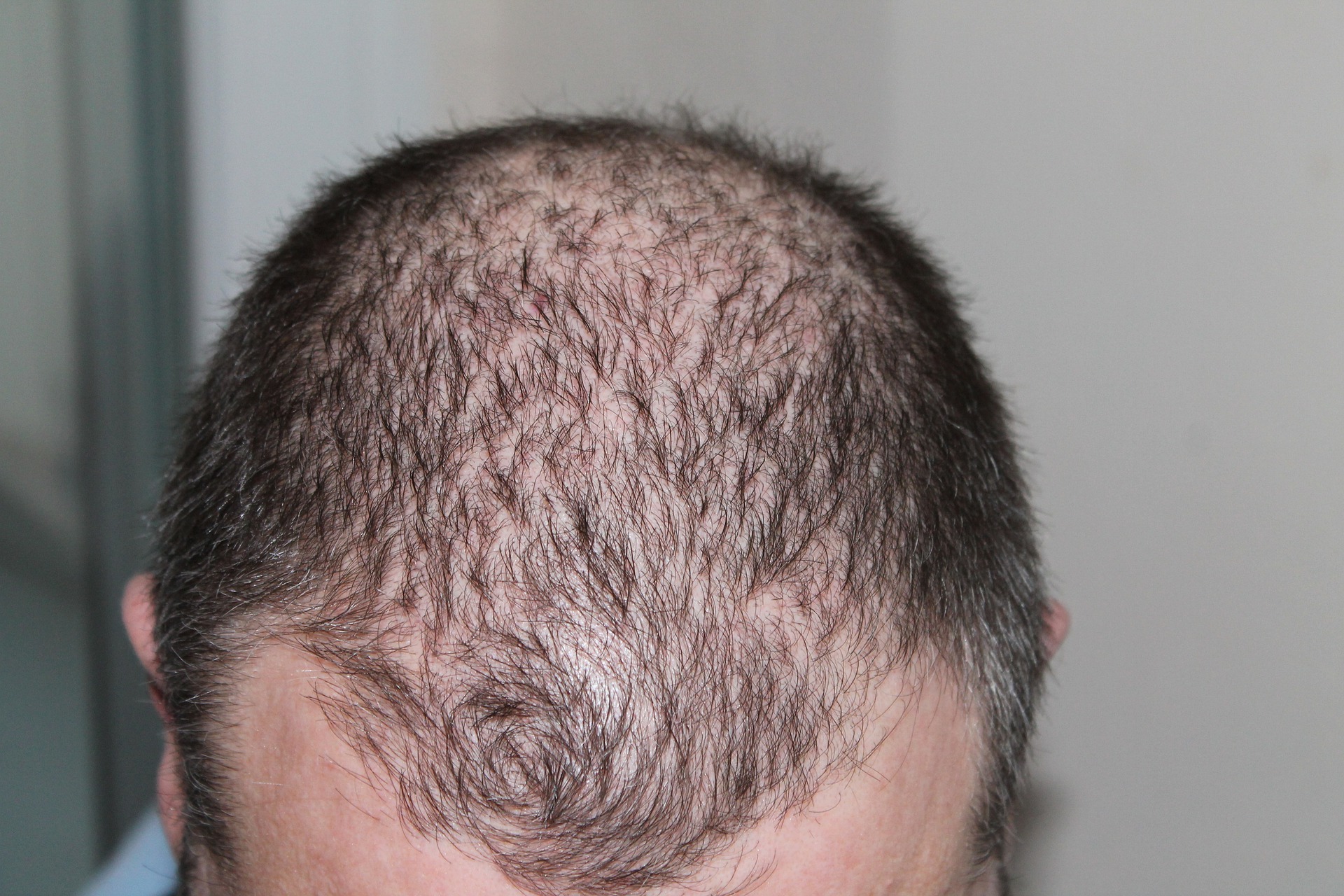 Új eredmények a férfiak hajhullásával kapcsolatban – közel a kopaszodás ellenszere?